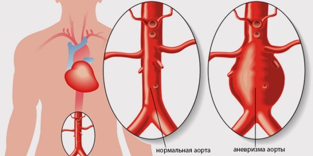 УЗД гілки дуги аорти з функціональними пробами у Львові