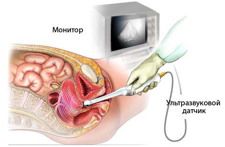 УЗД органів малого тазу у Львові