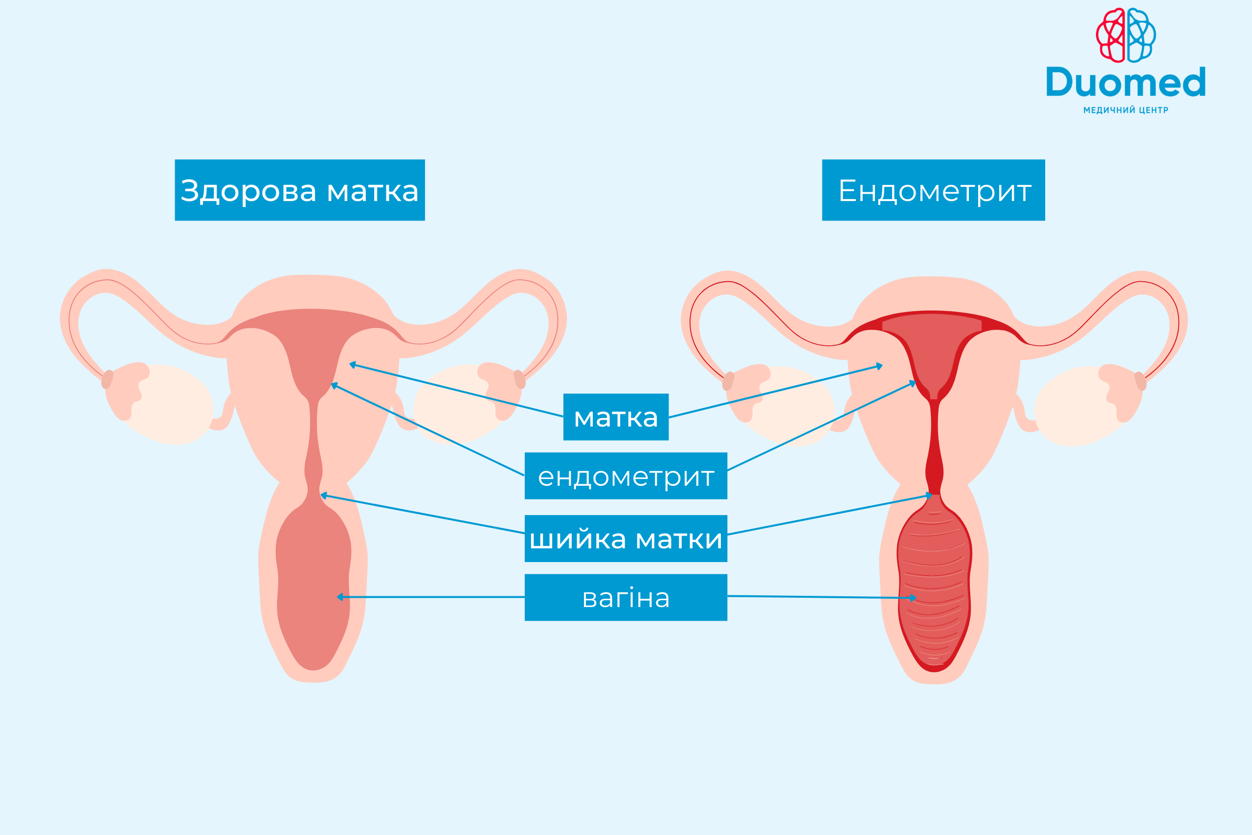 Ендометрит - що це, симптоми, діагностика, методи лікування - image 2